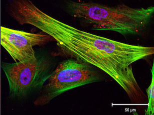 Seen through a microscope, these color-enhanced skin cells from progeria patients have been induced to become smooth muscle cells, some with abnormalities such as double nuclei. Image by Haoyue Zhang